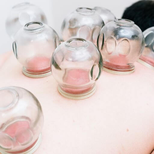 fire cupping